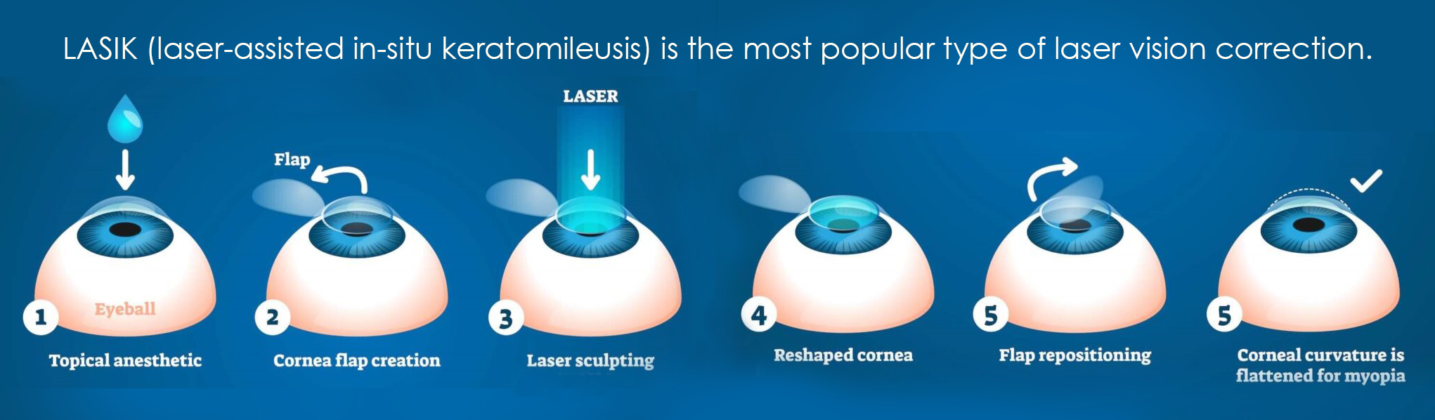 La procédure de correction de la vision au laser à Kyiv