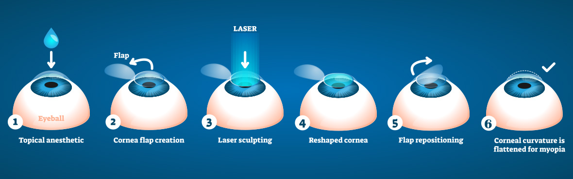 Chirurgie oculaire au laser en Ukraine