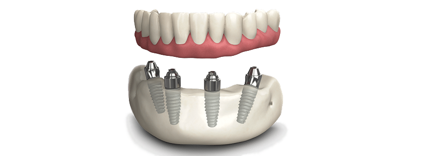 Comment les implants sont fixés à la mâchoire chez All on 4 