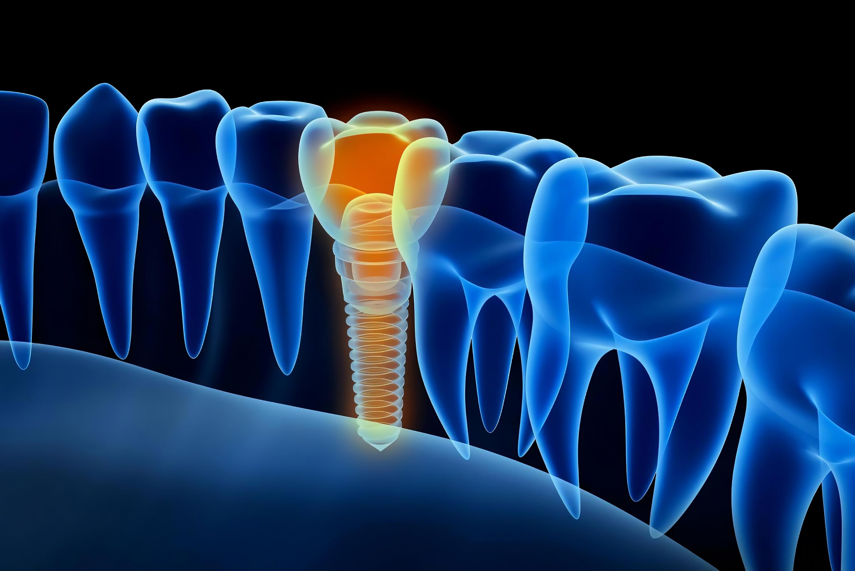 Ostéoporose et implants dentaires