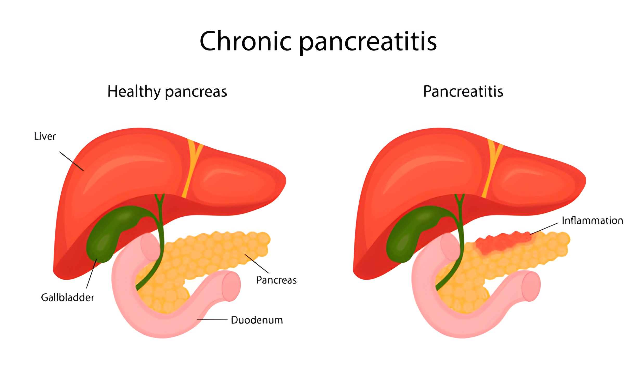 Quels sont les symptômes de la pancréatite chronique?