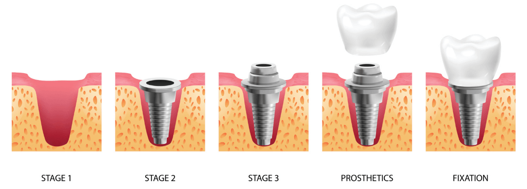 Étapes de la pose d'implants dentaires à Lviv