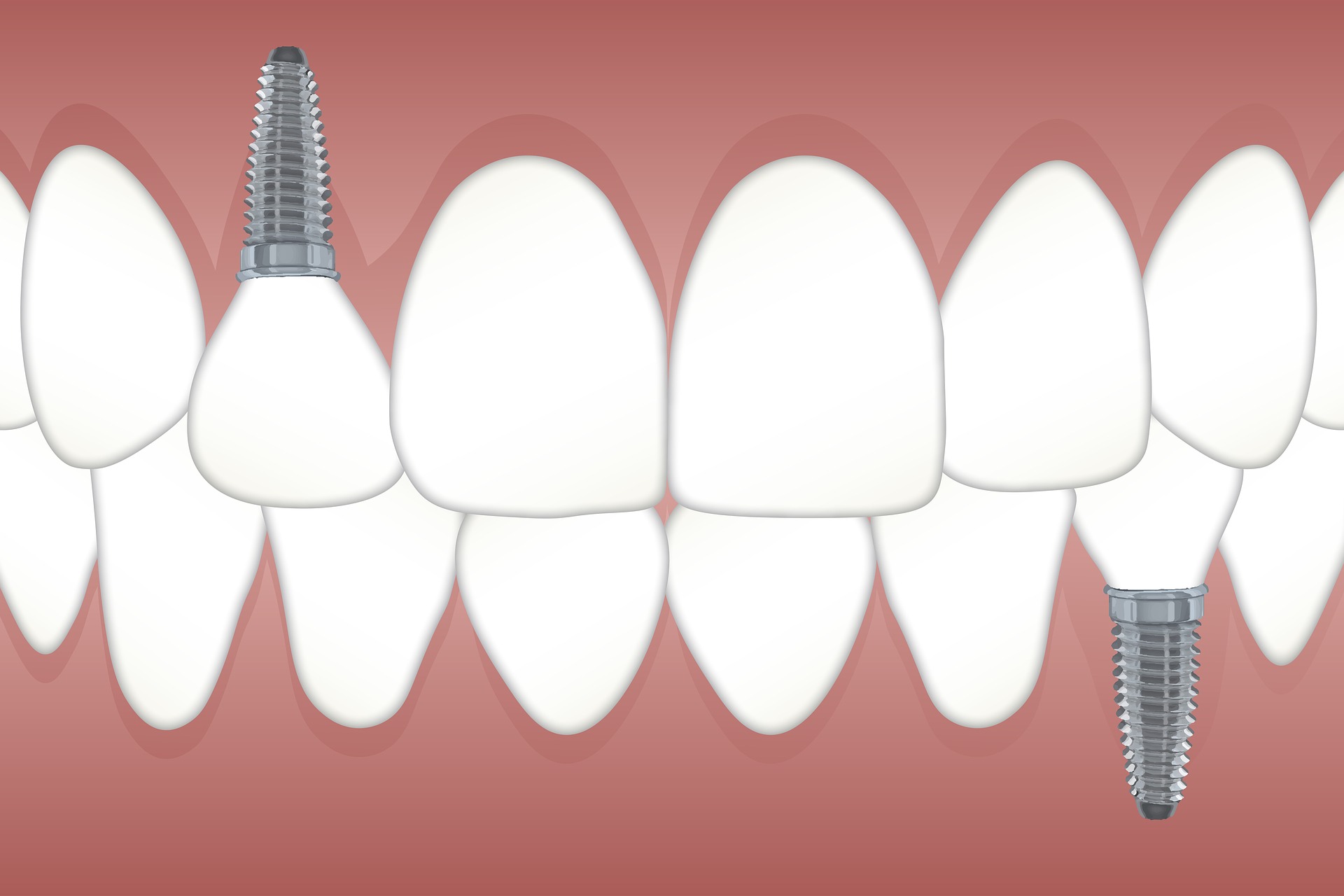 schéma illustrant l'apparence des implants dentaires