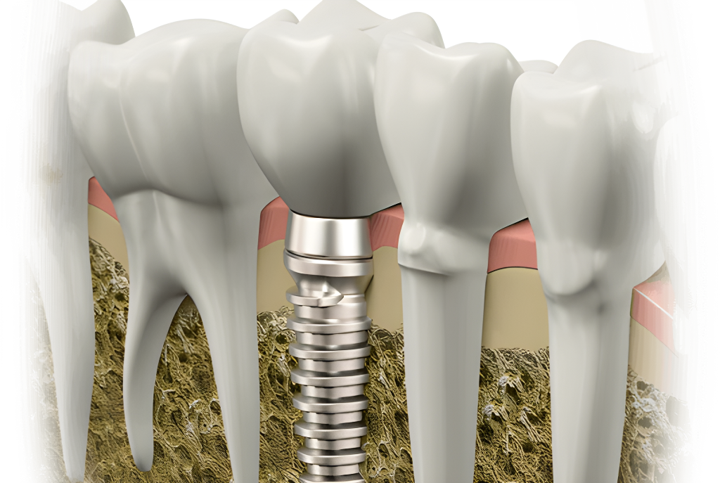 Implants dentaires israéliens